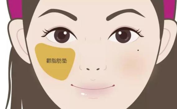 自体脂肪丰苹果肌的果好不好?填充后30天果反馈!