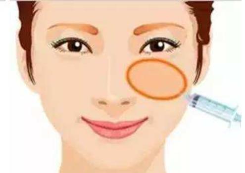 自体脂肪丰苹果肌的果好不好?填充后30天果反馈!