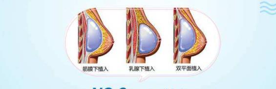 娜绮丽假体隆胸手术果好不好?有真人做胸部整形前后对比图分享!