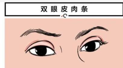 割双眼皮手术失败案例分享!失败的原因分析!戳进来看详情