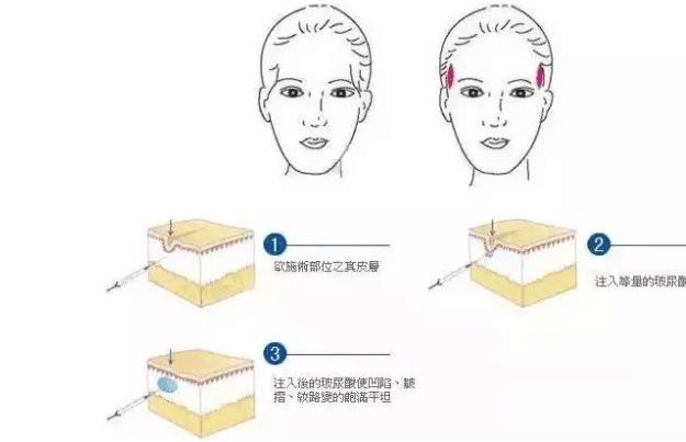 脂肪填充太阳穴亲身经历的分享!填充后15天果图来袭!