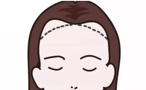 发际线整形价格一般在多少?果可以维持多久?术后如何护理呢?