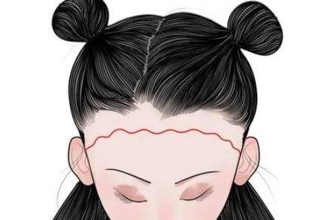 发际线整形价格一般在多少?果可以维持多久?术后如何护理呢?