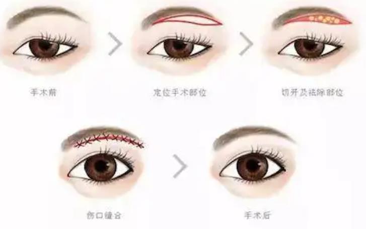 提眉术前后对比照片曝光!来看看做提眉后的真实体验分享吧!