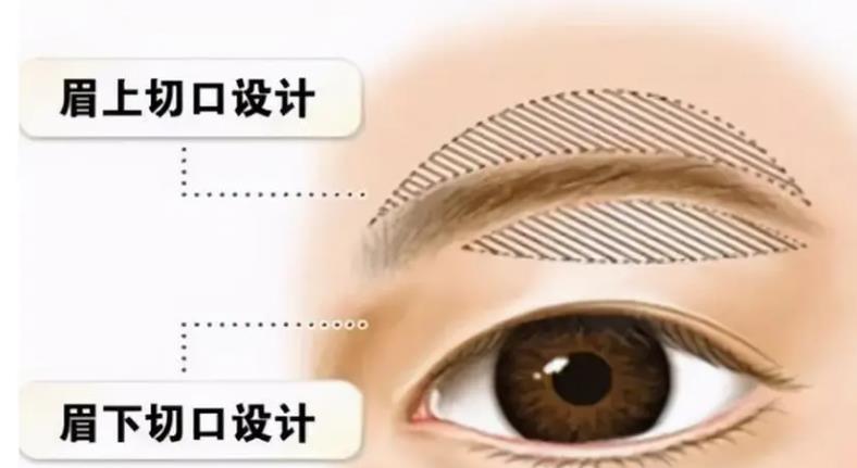 提眉术前后对比照片曝光!来看看做提眉后的真实体验分享吧!