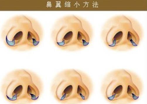 缩鼻翼前后对比照曝光！真人做鼻整形恢复过程图例分享！