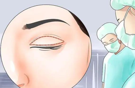 肿眼泡抽脂前后对照图曝光!抽脂后做双眼皮的果好不好?
