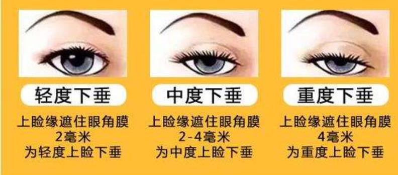 上睑下垂恢复期是多久？做眼部整形术前术后需要注意哪些事情？