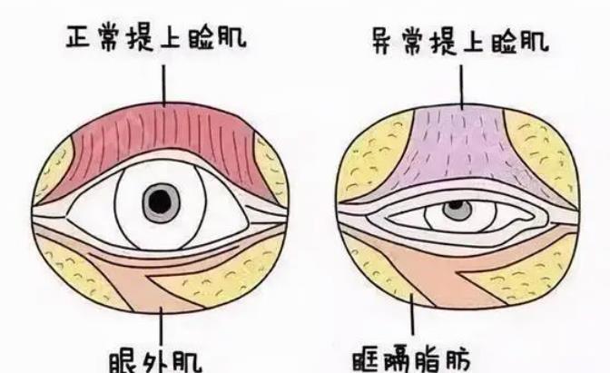 上睑下垂恢复期是多久？做眼部整形术前术后需要注意哪些事情？