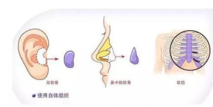 隆鼻手术危险吗？隆鼻手术选择那种材质好？注射v假体那种更可靠？