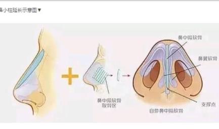 隆鼻手术危险吗？隆鼻手术选择那种材质好？注射v假体那种更可靠？