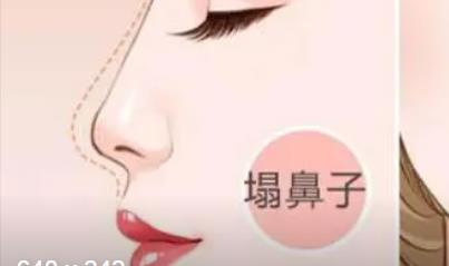 北京假体隆鼻修复案例分享!总体花费2w!自然、美观、大气!