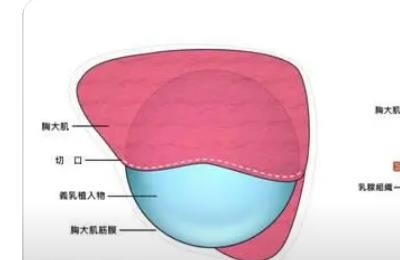 北京假体丰胸案例分享!三个月的蜕变豆包变面包,不信戳进来看看!
