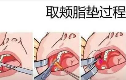 去颊脂对比照片公布!婴儿肥小美女~变身精致大美女!过程分享!
