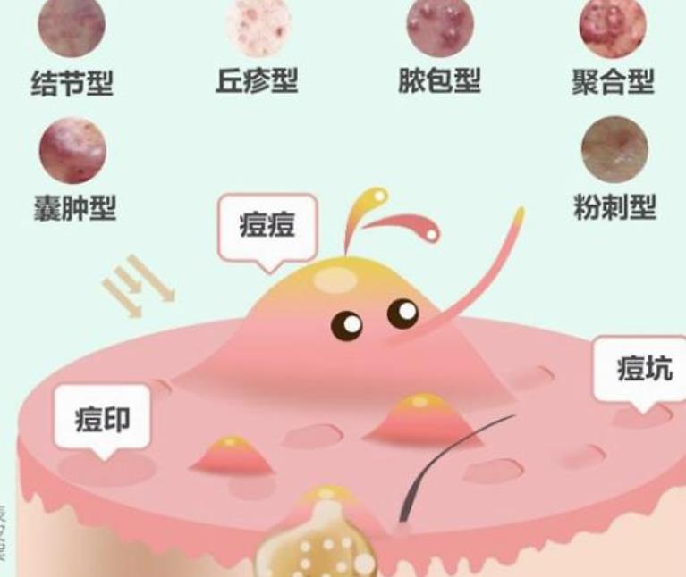 激光调节痤疮果怎么样?价格高吗?有副作用吗?