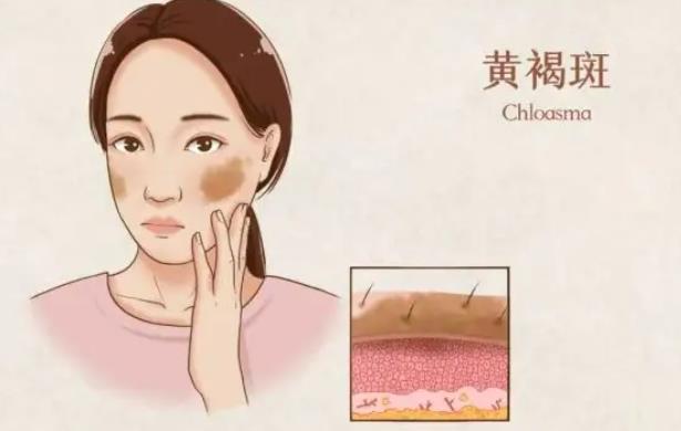 激光祛黄褐斑反多久可以恢复?果会反弹吗?做几次能去除干净?