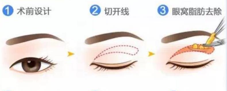 上海九院张余光医生擅长项目有哪些?坐诊医院及案例分享!
