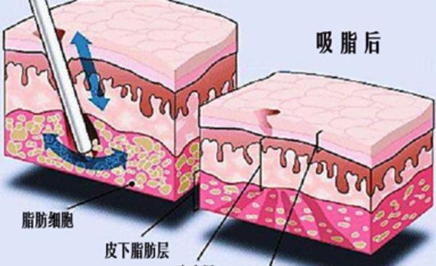 腹部吸脂的费用是多少？手术前后注意事项分享！