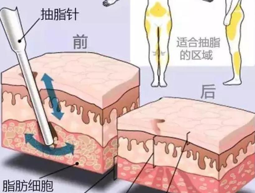 腹部吸脂的费用是多少？手术前后注意事项分享！