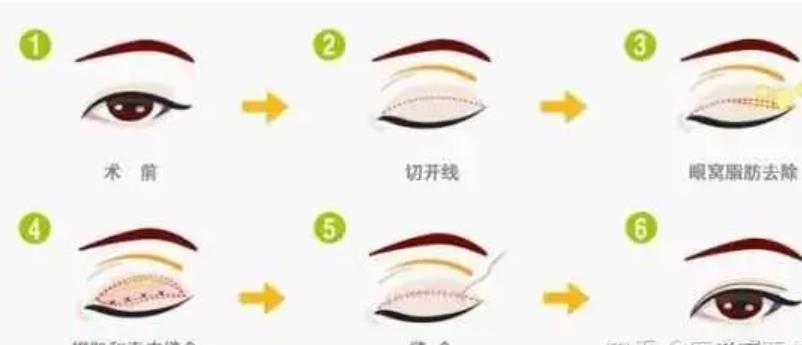 全切双眼皮1个月过程图分享!戳进来看看我的双眼皮做的自然吗?