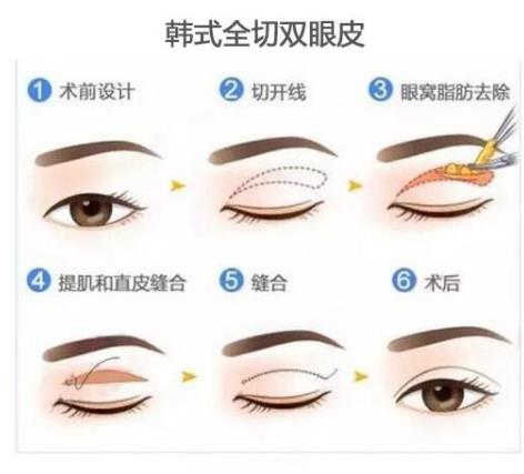 全切双眼皮1个月过程图分享!戳进来看看我的双眼皮做的自然吗?