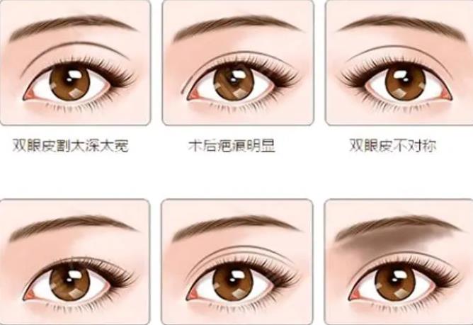 双眼皮术后恢复过程图分享|真人做双眼皮手术全过程分享!