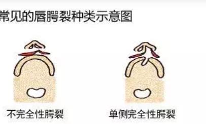 兔唇修复后图片曝光！兔唇可以用什么方法来修复？术后注意事项分享