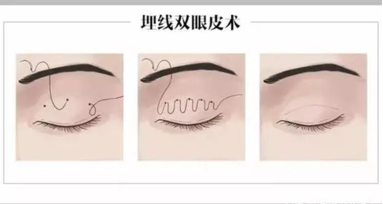 做双眼皮埋线好还是全切好?那种果更自然一些呢?