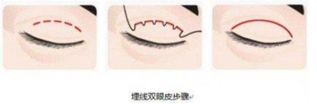 做双眼皮埋线好还是全切好?那种果更自然一些呢?