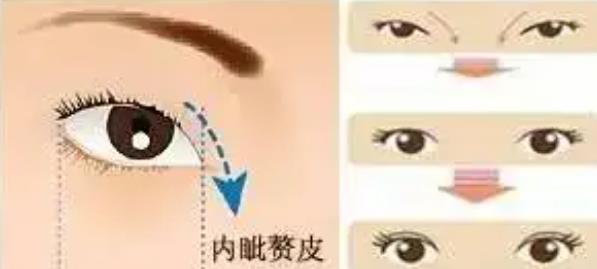 开眼角前后对比照片图!做开眼角真的能放大双眼吗?案例图示分享