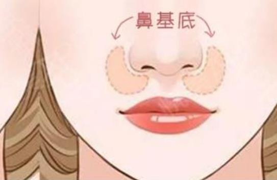 垫鼻子多少钱?做垫鼻子手术需要注意什么?价格很高吗?