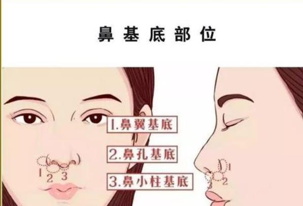 垫鼻子多少钱?做垫鼻子手术需要注意什么?价格很高吗?