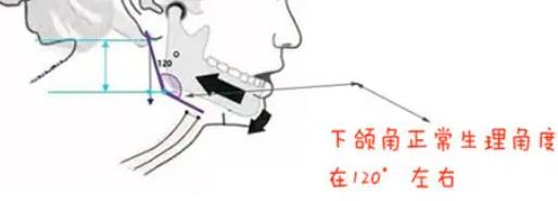 下颌角整形手术原理是什么?类型有几种?注意事项分享!