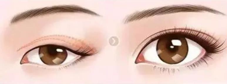 肿眼皮割双眼皮图片曝光!戳进来看看我这双眼皮算做成功了吗?
