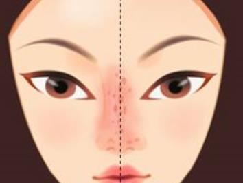 耳软骨垫鼻尖吸收率如何?做鼻尖整形之后如何护理?注意事项分享!