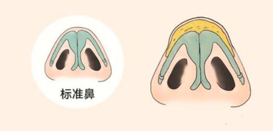 耳软骨垫鼻尖吸收率如何?做鼻尖整形之后如何护理?注意事项分享!