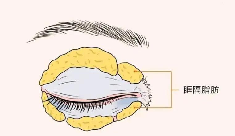 眼睑吸脂前后对比差别大吗?来看看真人做眼部整形案例图吧!