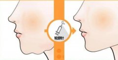 面部轮廓提升针有果吗？其主要成分是什么？果好吗？