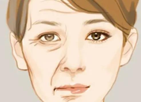 除鱼尾纹什么果好？激光vs玻尿酸那种可靠？内有价格参考