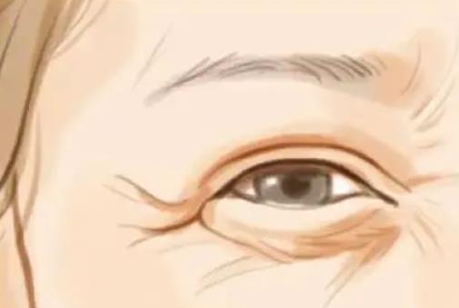 除鱼尾纹什么果好？激光vs玻尿酸那种可靠？内有价格参考
