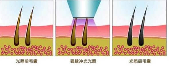 冰点脱毛价格一般多少钱?冰点脱毛优势介绍!果是的吗?