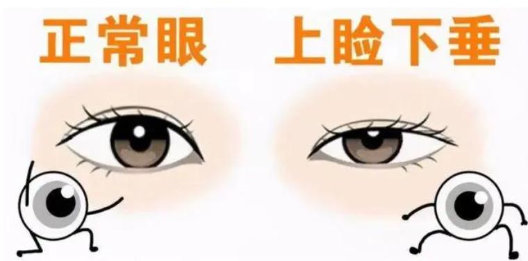 双眼皮