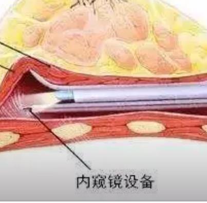 内窥镜假体丰胸案例分享!真手术过程揭秘!术后如何护理?