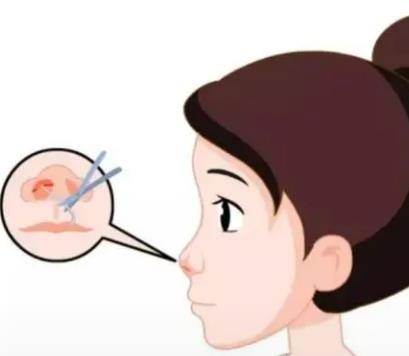 上海隆鼻失败修复手术!修复价格、手术开展攻略!戳进来查看!