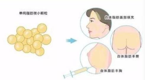 自体脂肪填充