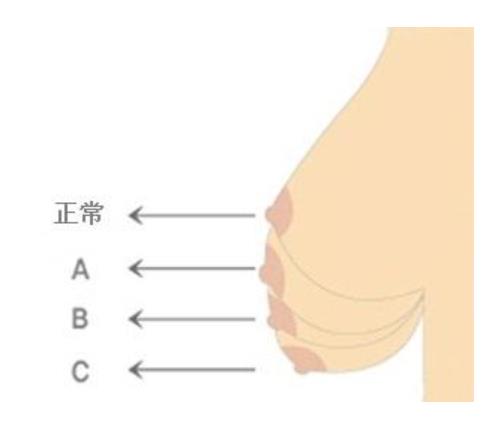 隆胸