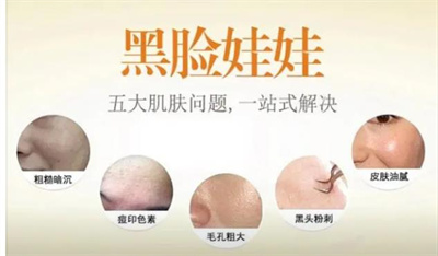 黑脸娃娃一个疗程变化!真的能改良毛孔粗大?暗沉吗? 附恢复过程!
