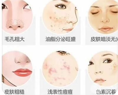 黑脸娃娃一个疗程变化!真的能改良毛孔粗大?暗沉吗? 附恢复过程!