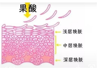 果酸焕肤的果怎么样?真人案例分享!肌肤透亮,有光泽!