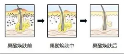 果酸焕肤的果怎么样?真人案例分享!肌肤透亮,有光泽!